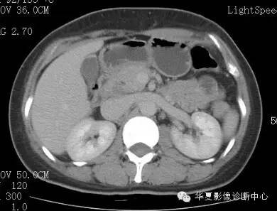 【病例】胰周淋巴结结核1例CT影像表现 【病例】胰周淋巴结结核1例CT影像表现