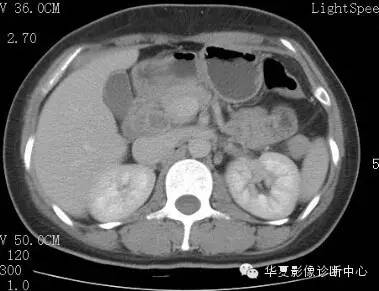 【病例】胰周淋巴结结核1例CT影像表现 【病例】胰周淋巴结结核1例CT影像表现