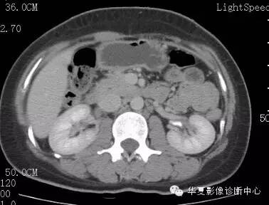 【病例】胰周淋巴结结核1例CT影像表现 【病例】胰周淋巴结结核1例CT影像表现