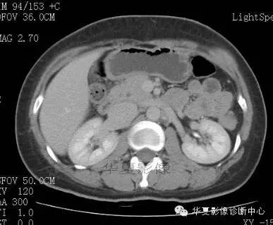 【病例】胰周淋巴结结核1例CT影像表现 【病例】胰周淋巴结结核1例CT影像表现