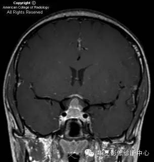 【病例】肉芽肿性垂体炎1例CT及MR影像表现