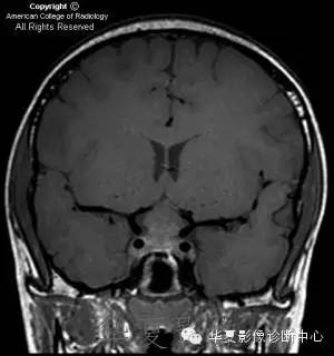 【病例】肉芽肿性垂体炎1例CT及MR影像表现