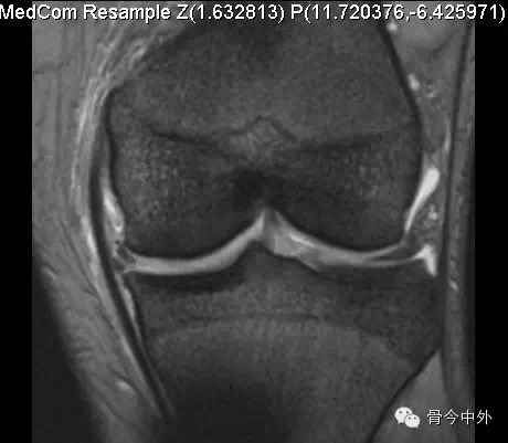 半月板损伤的MRI表现 半月板损伤的MRI表现