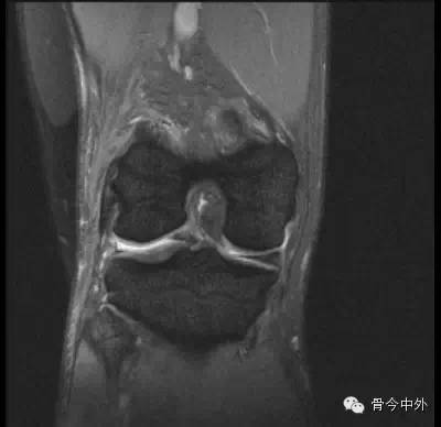 半月板损伤的MRI表现 半月板损伤的MRI表现