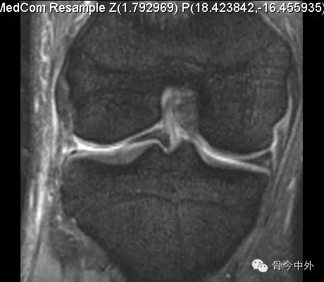 半月板损伤的MRI表现 半月板损伤的MRI表现
