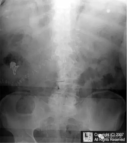 【病例】开腹手术纱布残留1例X线影像表现