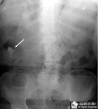【病例】开腹手术纱布残留1例X线影像表现