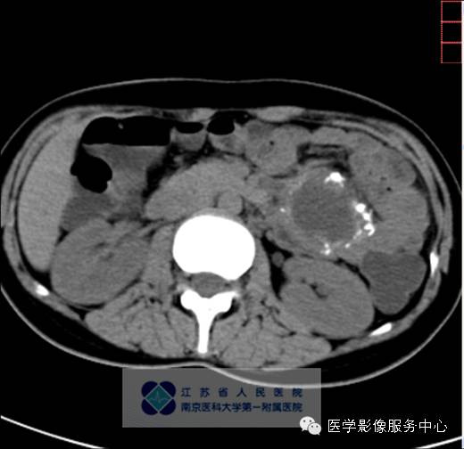 【病例】胰腺实性假乳头状肿瘤1例CT影像表现
