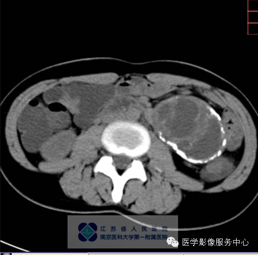 【病例】胰腺实性假乳头状肿瘤1例CT影像表现 【病例】胰腺实性假乳头状肿瘤1例CT影像表现