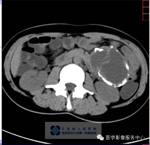 【病例】胰腺实性假乳头状肿瘤1例CT影像表现 【病例】胰腺实性假乳头状肿瘤1例CT影像表现