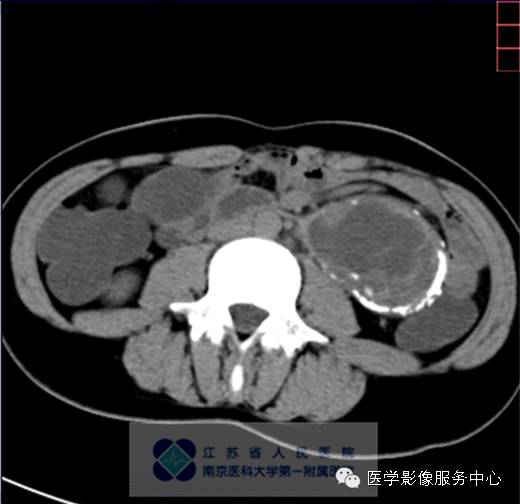 【病例】胰腺实性假乳头状肿瘤1例CT影像表现 【病例】胰腺实性假乳头状肿瘤1例CT影像表现