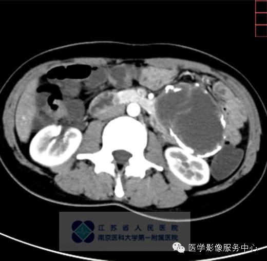 【病例】胰腺实性假乳头状肿瘤1例CT影像表现 【病例】胰腺实性假乳头状肿瘤1例CT影像表现