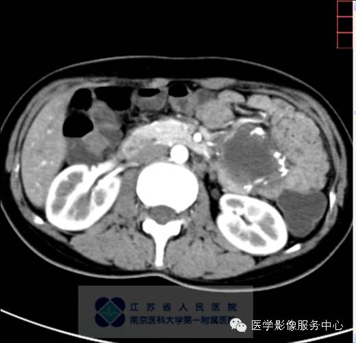 【病例】胰腺实性假乳头状肿瘤1例CT影像表现 【病例】胰腺实性假乳头状肿瘤1例CT影像表现