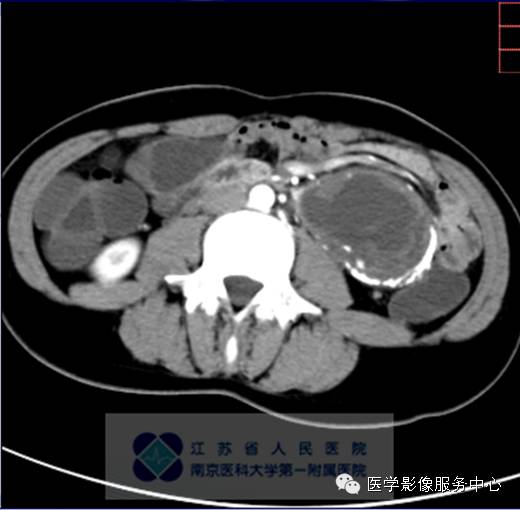 【病例】胰腺实性假乳头状肿瘤1例CT影像表现 【病例】胰腺实性假乳头状肿瘤1例CT影像表现