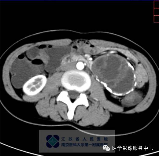 【病例】胰腺实性假乳头状肿瘤1例CT影像表现 【病例】胰腺实性假乳头状肿瘤1例CT影像表现