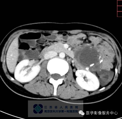 【病例】胰腺实性假乳头状肿瘤1例CT影像表现 【病例】胰腺实性假乳头状肿瘤1例CT影像表现