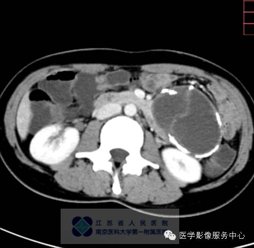 【病例】胰腺实性假乳头状肿瘤1例CT影像表现 【病例】胰腺实性假乳头状肿瘤1例CT影像表现