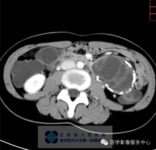 【病例】胰腺实性假乳头状肿瘤1例CT影像表现 【病例】胰腺实性假乳头状肿瘤1例CT影像表现