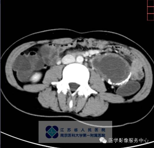 【病例】胰腺实性假乳头状肿瘤1例CT影像表现 【病例】胰腺实性假乳头状肿瘤1例CT影像表现