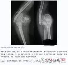 Charcot关节 Charcot关节
