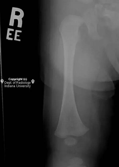 【病例】生理性骨膜反应1例X线影像表现