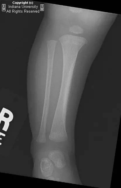 【病例】生理性骨膜反应1例X线影像表现