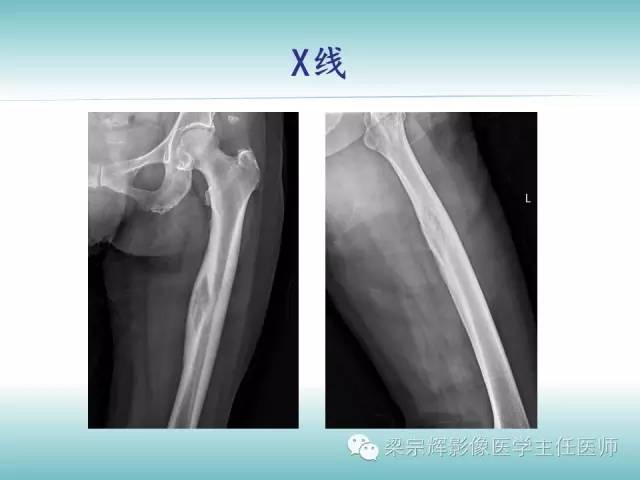 【病例】股骨骨皮质转移瘤1例影像表现