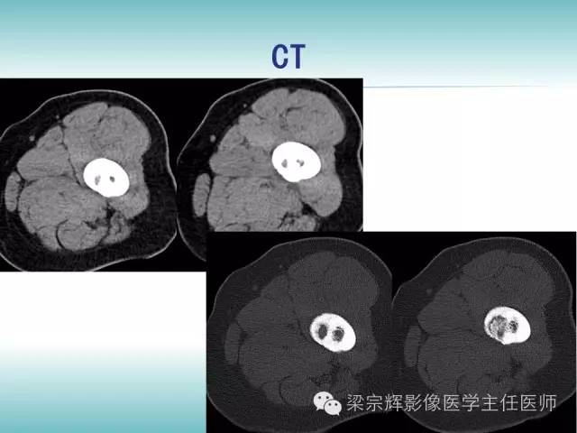 【病例】股骨骨皮质转移瘤1例影像表现