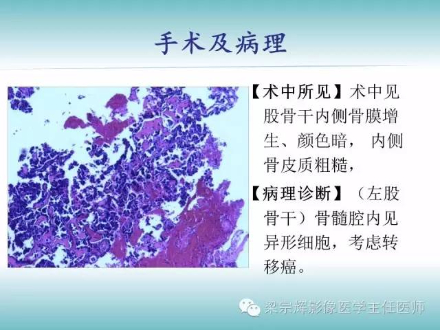 【病例】股骨骨皮质转移瘤1例影像表现