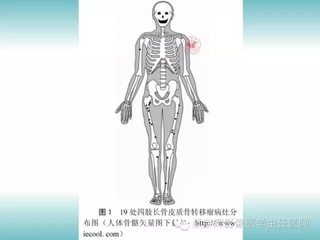 【病例】股骨骨皮质转移瘤1例影像表现