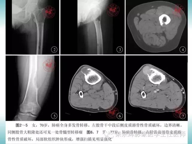 【病例】股骨骨皮质转移瘤1例影像表现