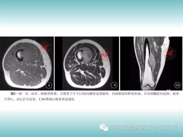 【病例】股骨骨皮质转移瘤1例影像表现