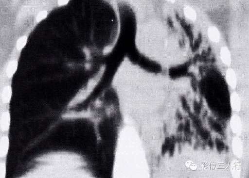 “支气管内赘生物” 的CT表现