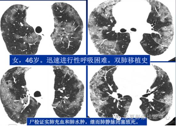 肺静脉闭塞病（PVOD）--带你了解不一样的肺动脉高压