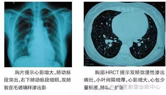 肺静脉闭塞病（PVOD）--带你了解不一样的肺动脉高压