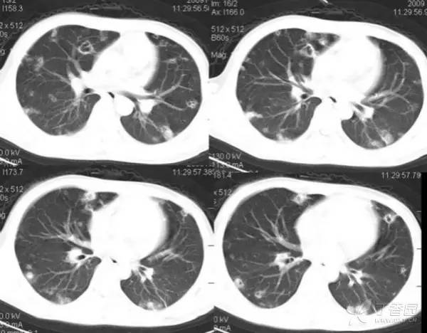 一病多像 一像多病:经典胸部 CT 之感染篇 一病多像 一像多病:经典胸部 CT 之感染篇