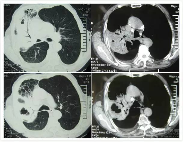 一病多像 一像多病:经典胸部 CT 之感染篇 一病多像 一像多病:经典胸部 CT 之感染篇