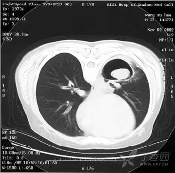 一病多像 一像多病:经典胸部 CT 之感染篇 一病多像 一像多病:经典胸部 CT 之感染篇