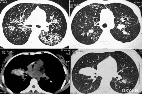 一病多像 一像多病:经典胸部 CT 之感染篇 一病多像 一像多病:经典胸部 CT 之感染篇