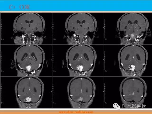 【病例】血管母细胞瘤1例MR影像表现 【病例】血管母细胞瘤1例MR影像表现