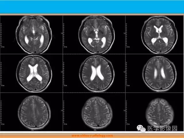 【病例】血管母细胞瘤1例MR影像表现 【病例】血管母细胞瘤1例MR影像表现