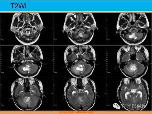 【病例】血管母细胞瘤1例MR影像表现 【病例】血管母细胞瘤1例MR影像表现