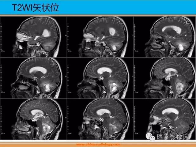 【病例】血管母细胞瘤1例MR影像表现 【病例】血管母细胞瘤1例MR影像表现