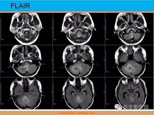 【病例】血管母细胞瘤1例MR影像表现 【病例】血管母细胞瘤1例MR影像表现