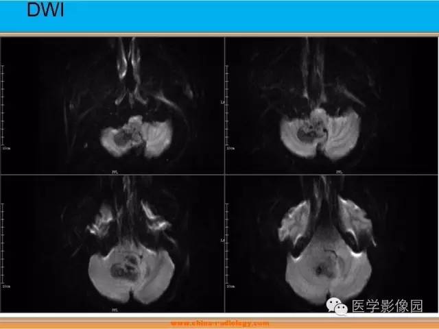 【病例】血管母细胞瘤1例MR影像表现 【病例】血管母细胞瘤1例MR影像表现