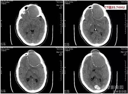 【病例】额窦巨大粘液囊肿1例MR影像表现