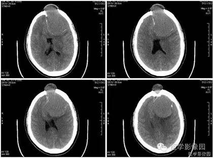 【病例】额窦巨大粘液囊肿1例MR影像表现 【病例】额窦巨大粘液囊肿1例MR影像表现