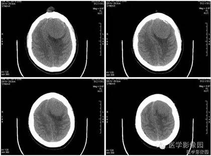 【病例】额窦巨大粘液囊肿1例MR影像表现 【病例】额窦巨大粘液囊肿1例MR影像表现