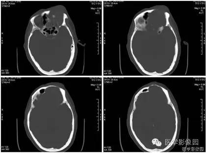 【病例】额窦巨大粘液囊肿1例MR影像表现 【病例】额窦巨大粘液囊肿1例MR影像表现