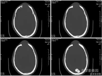 【病例】额窦巨大粘液囊肿1例MR影像表现 【病例】额窦巨大粘液囊肿1例MR影像表现